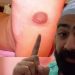 Kasus Unik Puting Payudara Tumbuh di Telapak Kaki, Ini Penjelasan Dokter