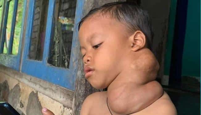 Pemda dan Dinas Kesehatan Anak akan Bekerjasama Lakukan Pengobatan Penderita Kanker di Sakra